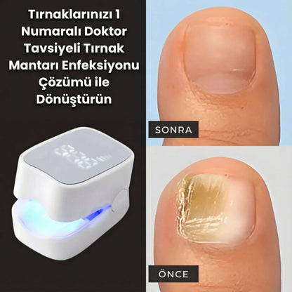 PureNail™ – Lazerli Tırnak Terapi Cihazı